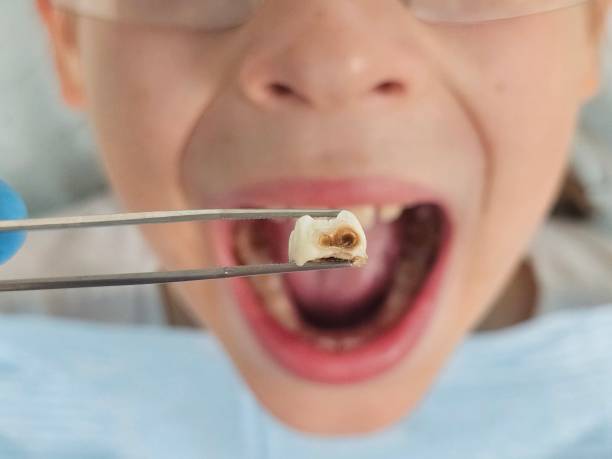 Best Emergency Dental Care for Abscessed Tooth in Ferguson, MO